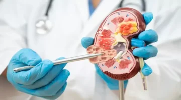 لماذا تشكل الوجبات السريعة خطراً مباشراً على صحة وظائف الكلى البشرية؟